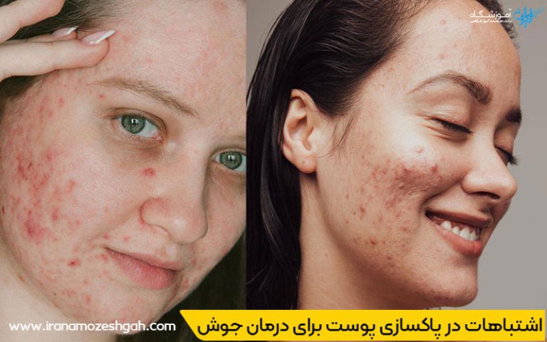 اشتباهات رایج در پاکسازی پوست برای درمان جوش