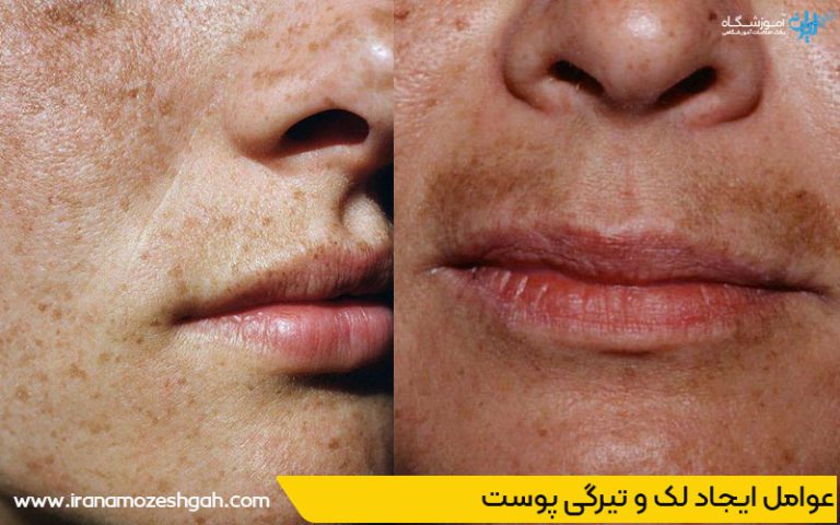 عوامل ایجاد لک و تیرگی پوست