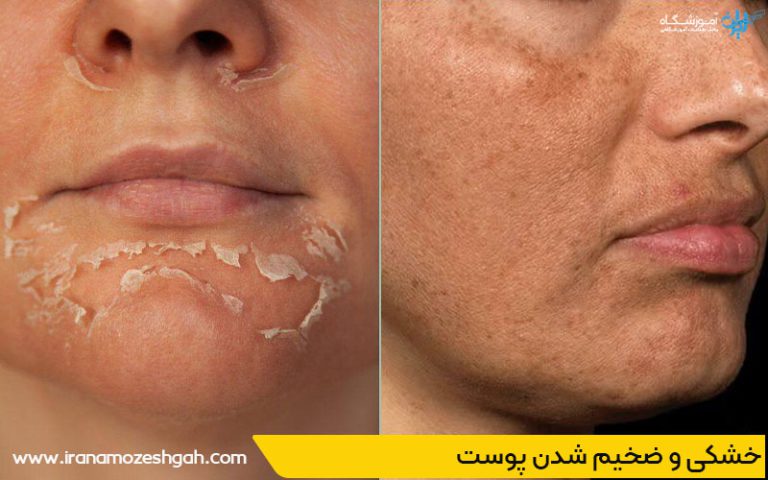 اثرات جانبی احتمالی پاکسازی پوست