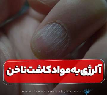 همه چیز درباره آلرژی به مواد کاشت ناخن