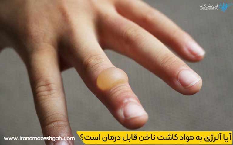 آیا آلرژی به مواد کاشت ناخن قابل درمان است