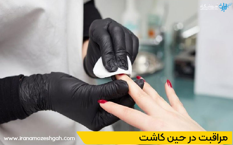 مراقبت در حین کاشت ناخن