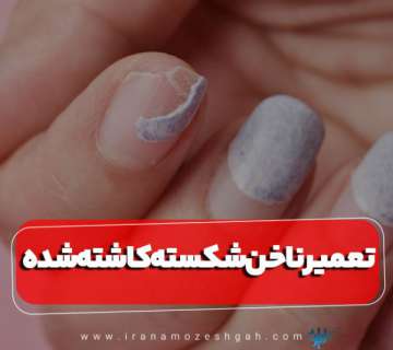 ترمیم ناخن شکسته کاشته شده