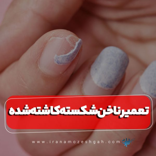 ترمیم ناخن شکسته کاشته شده
