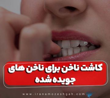 کاشت ناخن برای ناخن های جویده شده