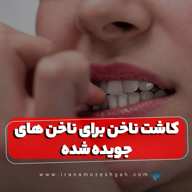 کاشت ناخن برای ناخن های جویده شده