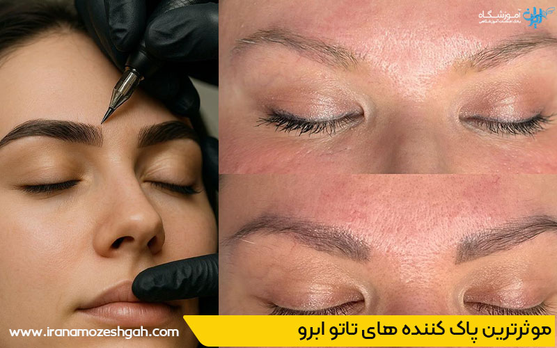 قوی ترین پاک کننده تاتو ابرو