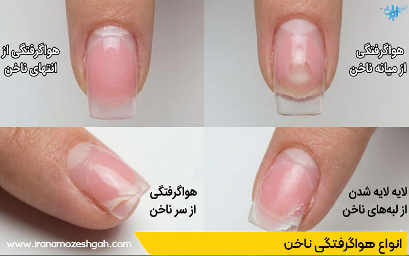 انواع هواگرفتگی ناخن
